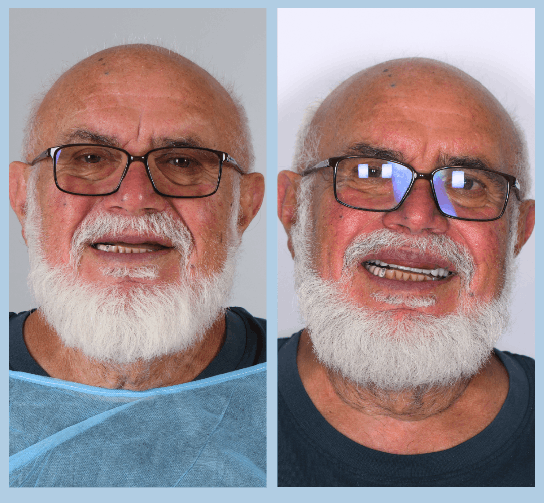 Caz clinic Smart Dental – înainte și după tratament (10)