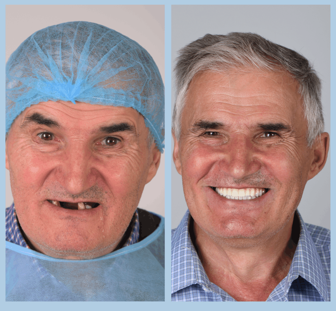 Caz clinic Smart Dental – înainte și după tratament (9)