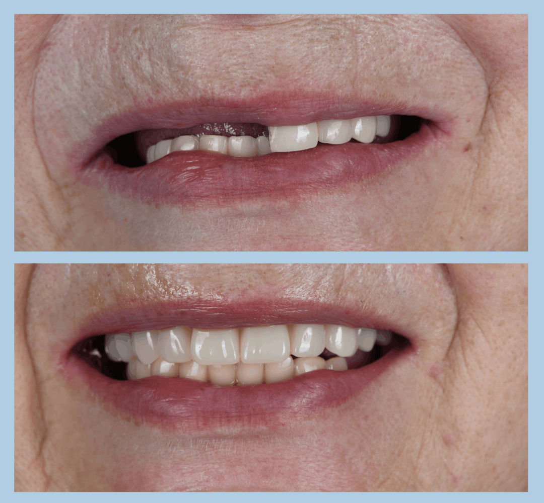 Caz clinic Smart Dental – înainte și după tratament (8)