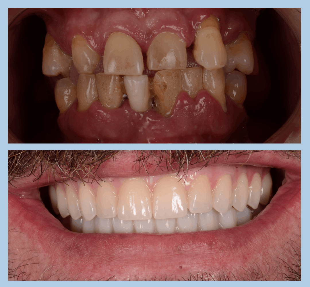 Caz clinic Smart Dental – înainte și după tratament (7)