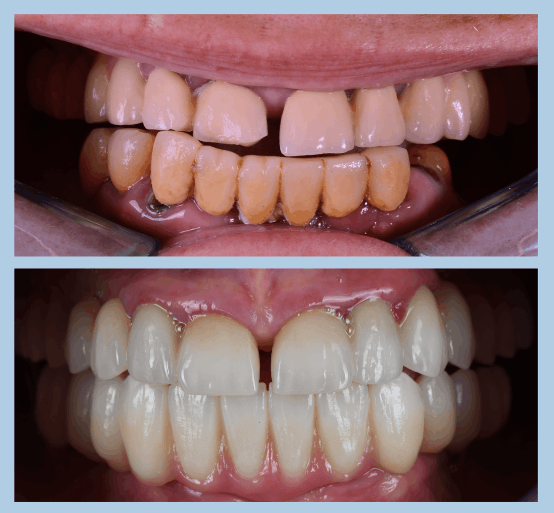 Caz clinic Smart Dental – înainte și după tratament (6)