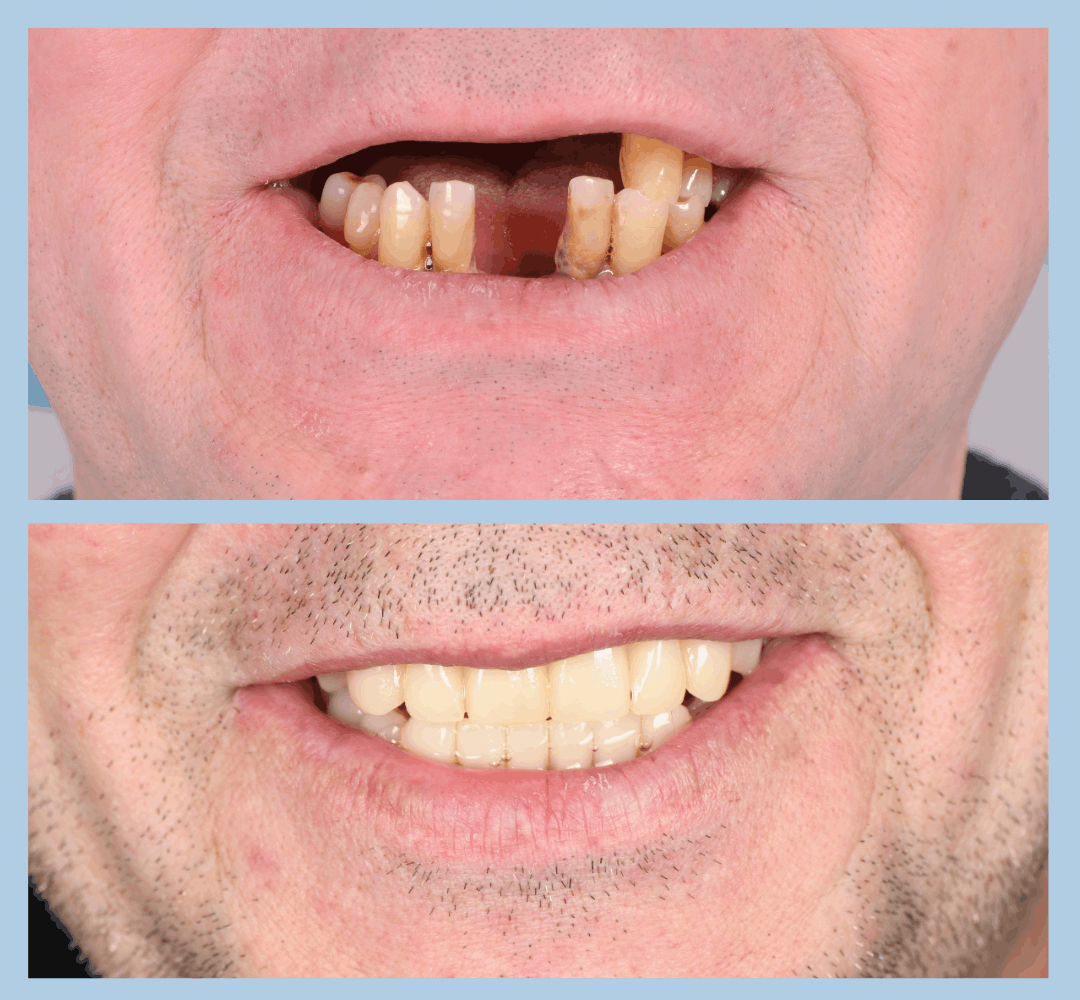 Caz clinic Smart Dental – înainte și după tratament (5)