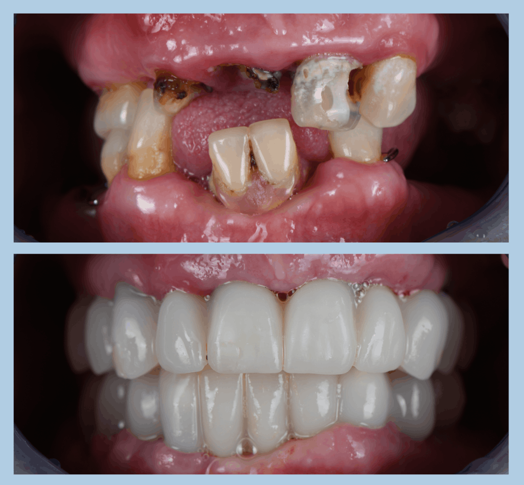 Caz clinic Smart Dental – înainte și după tratament (4)