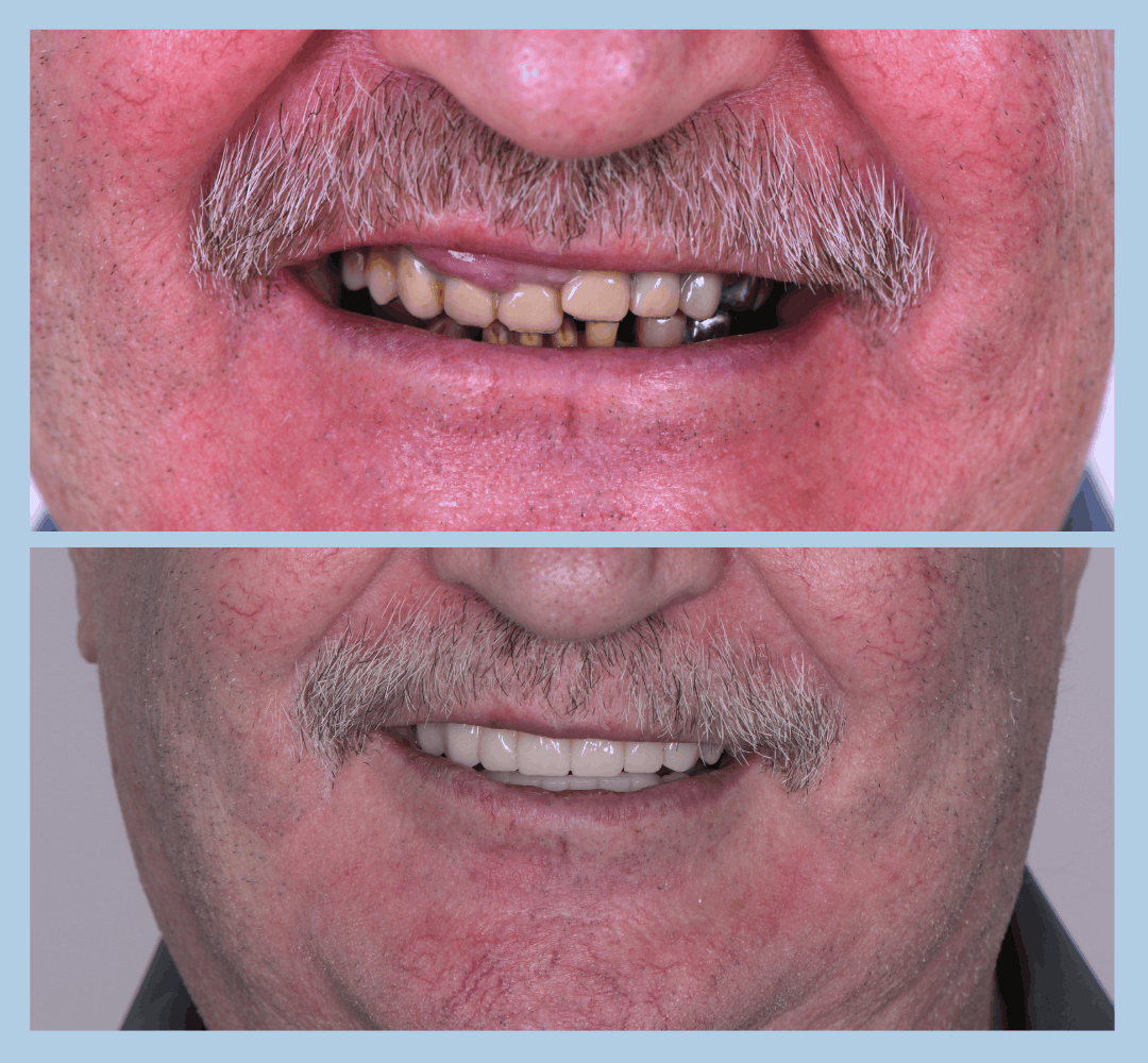 Caz clinic Smart Dental – înainte și după tratament (3)
