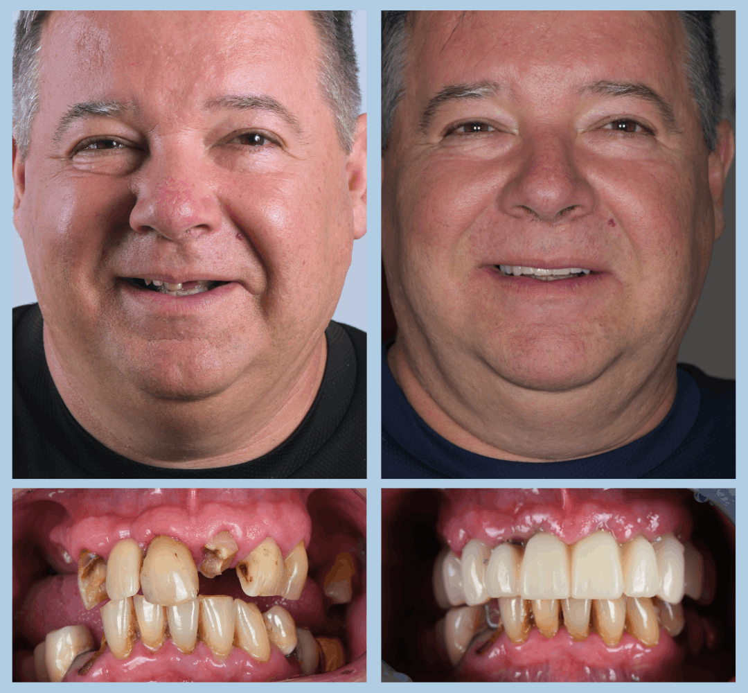 Caz clinic Smart Dental – înainte și după tratament (1)