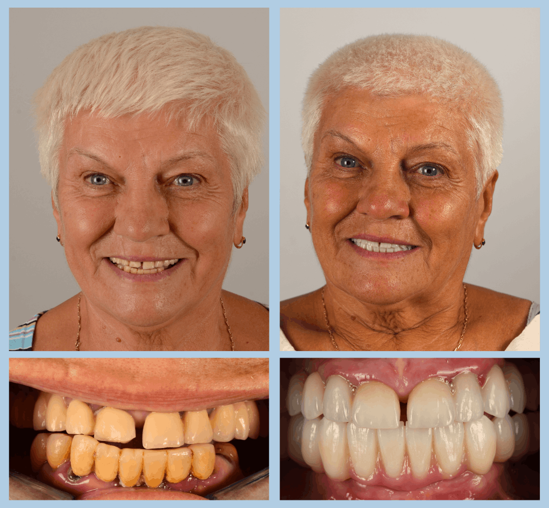 Caz clinic Smart Dental – înainte și după tratament (15)