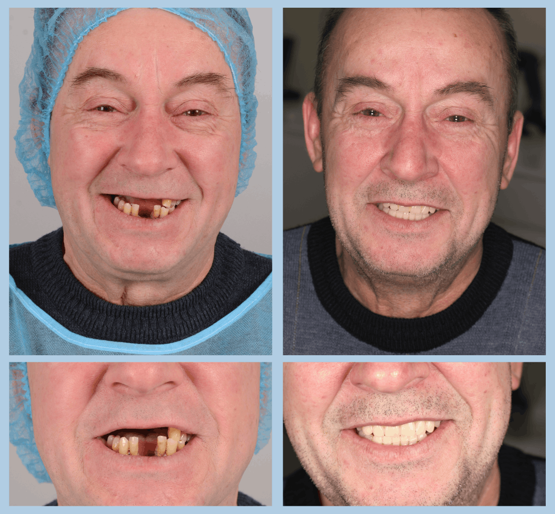 Caz clinic Smart Dental – înainte și după tratament (14)