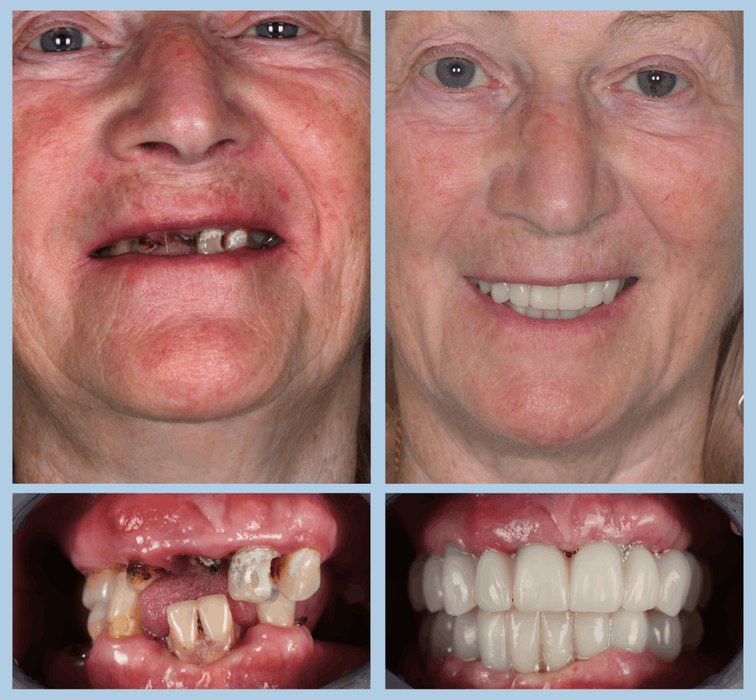Caz clinic Smart Dental – înainte și după tratament (13)