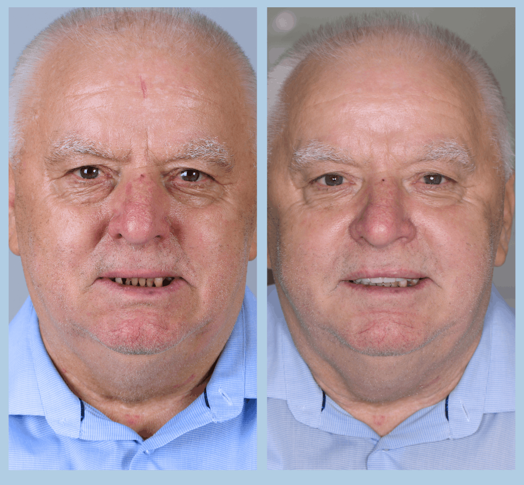 Caz clinic Smart Dental – înainte și după tratament (12)