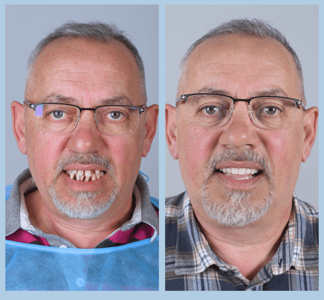 Caz clinic Smart Dental – înainte și după tratament (11)